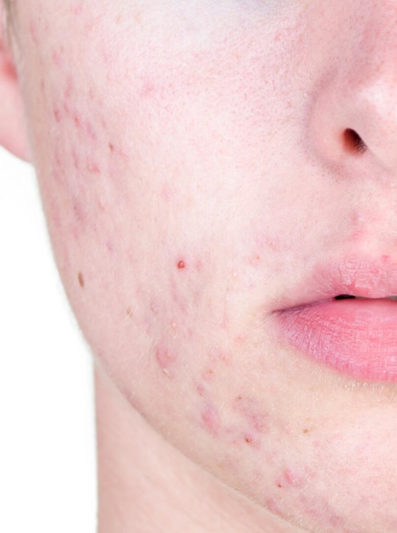 Acne around the mouth